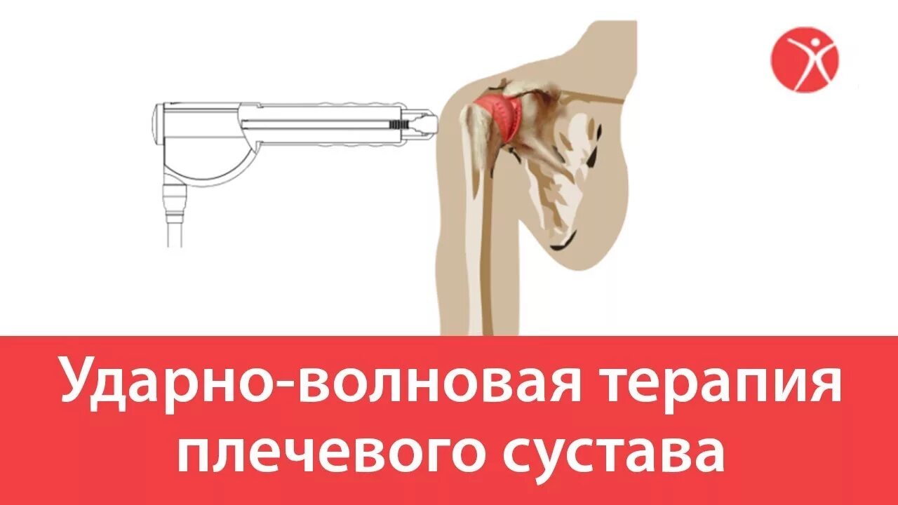 Увт тазобедренного сустава. Ударно-волновая терапия плечевого сустава. увт плечевого сустава. методика ударно-волновая терапия плечевого сустава. ударно-волновая терапия тазобедренного сустава.