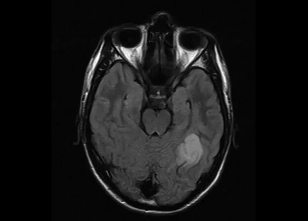 Лейкоэнцефалит. Лейкоэнцефалит ван богарта. мрт лейкоэнцефалит ван богарта. лейкоэнцефалит шильдера мрт. энцефалит шильдера мрт.