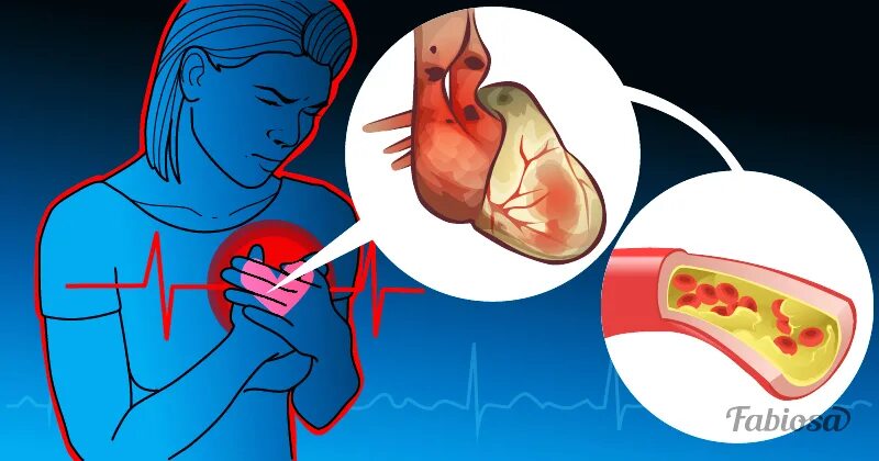 Инсульт холестерин. Организм намекает нам о больном сердце.