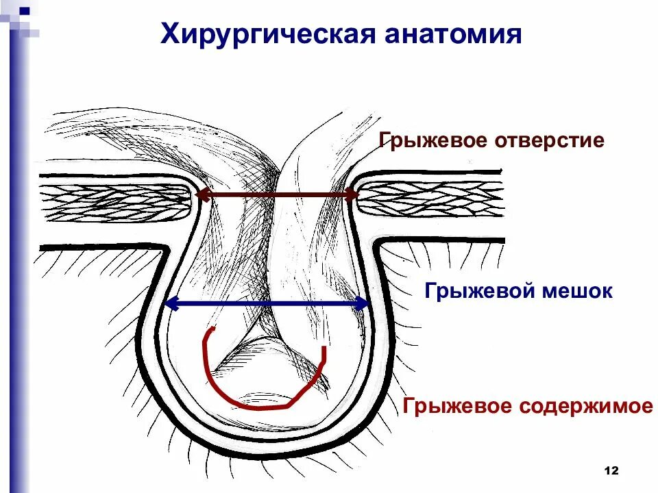 Косая паховая грыжа хирургическая анатомия. Грыжевые ворота грыжевой мешок грыжевое содержимое. Ущемленная косая паховая грыжа. Прямая и косая паховые грыжи