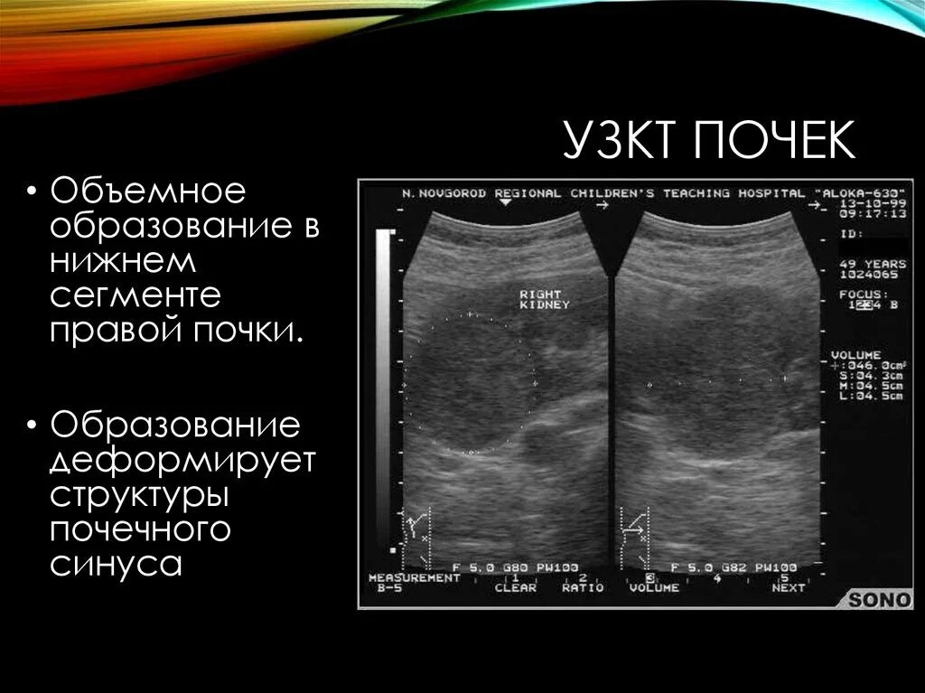 Образования в почке у мужчин. Образование в почке почки УЗИ. Объемное образование почки. Объемное образование в почке на УЗИ что это.