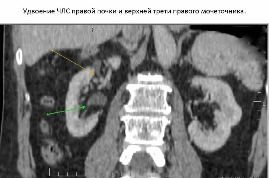 Расширенная члс. Удвоение лоханки почки кт. Удвоение чашечно-лоханочной системы почек кт. Частичное удвоение ЧЛС почек.