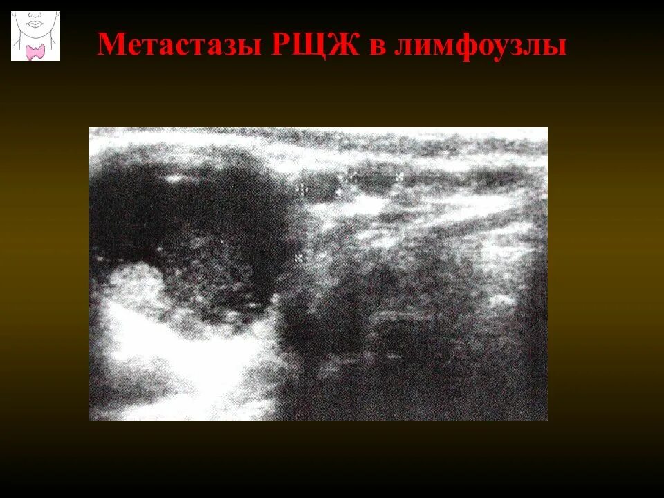 Метастазы в щитовидной железе на УЗИ. Метастазы в лимфоузлы на УЗИ. Метастазы в лимфатические узлы УЗИ. Щитовидная железа узи лимфоузлы