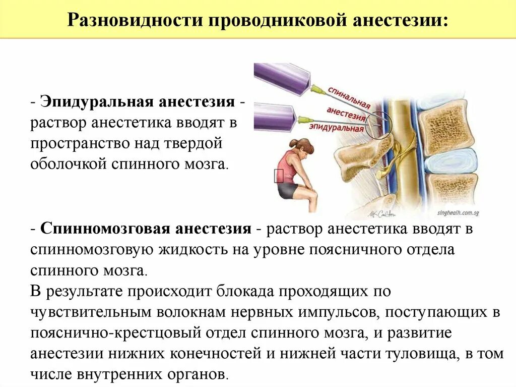 Эпидуральная спинная. Эпидуральная анестезия состав препарата. Люмбальная эпидуральная анестезия. Спинальная и эпидуральная анестезия. Эпидуральная анестезия и спинальная анестезия.