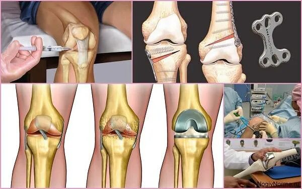 Коленный сустав по стадиям. Гонартроз остеоартроз.