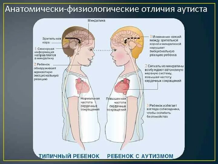 Аутизм головного мозга. Строение мозга при аутизме. Аутизм головного мозга. Причины возникновения детского аутизма. Аутизм головного мозга.