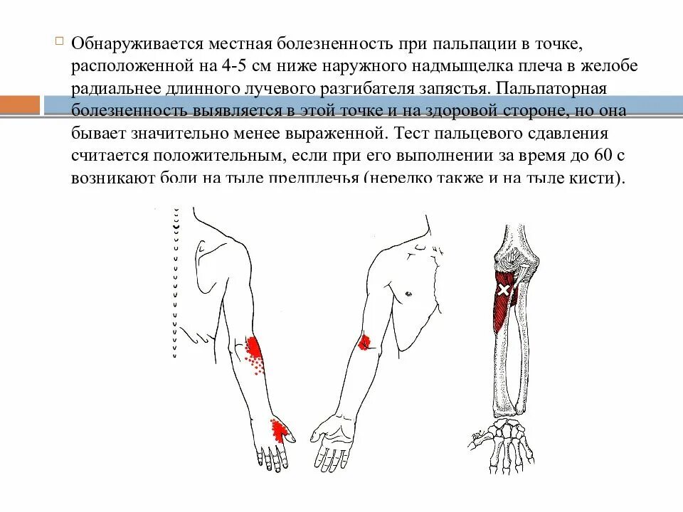 Туннельные невропатии верхних. Туннельный синдром ТБС. Тональный синдром верхних конечностей. Туннельные синдромы верхних конечностей.