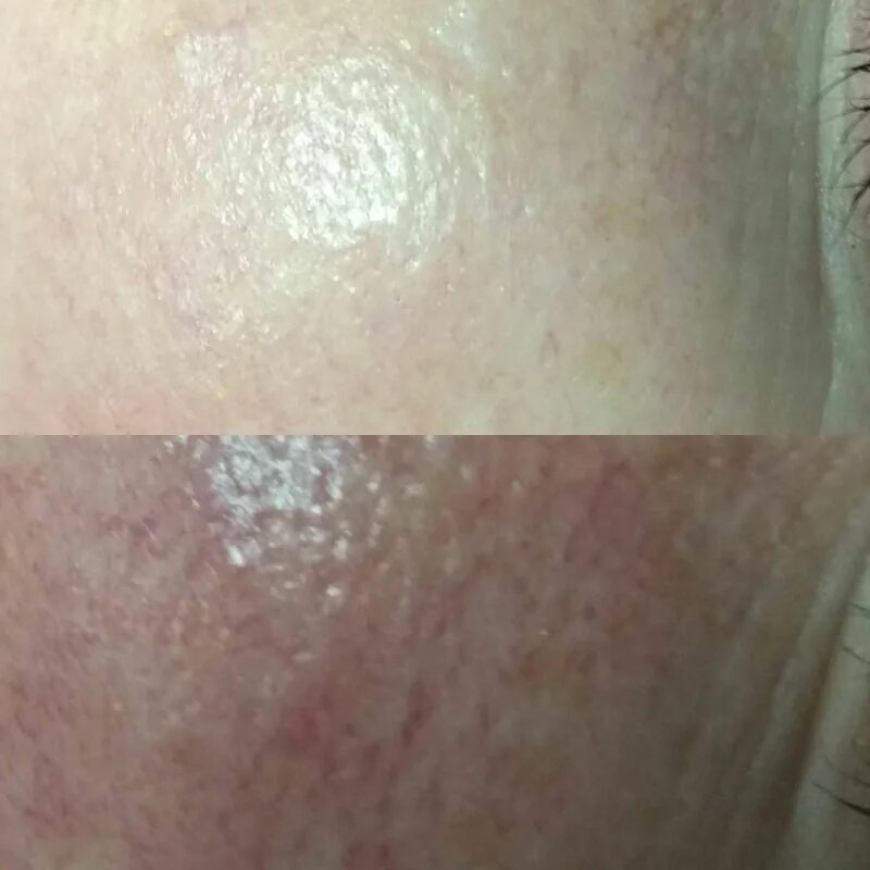 Карбокситерапия для лица до и после. Можно ли пилинг при куперозе. Можно ли пилинг при куперозе. Феруловый пилинг до и после. Папулопустулёзной розацеа.