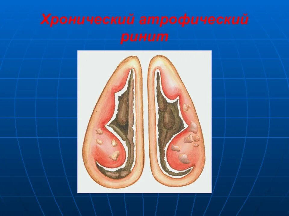 Катаральный насморк. Хронический атрофический ринит. Вазомоторный ринит риноскопия. Вазомоторный гипертрофический ринит. Озена - атрофический хронический ринит.