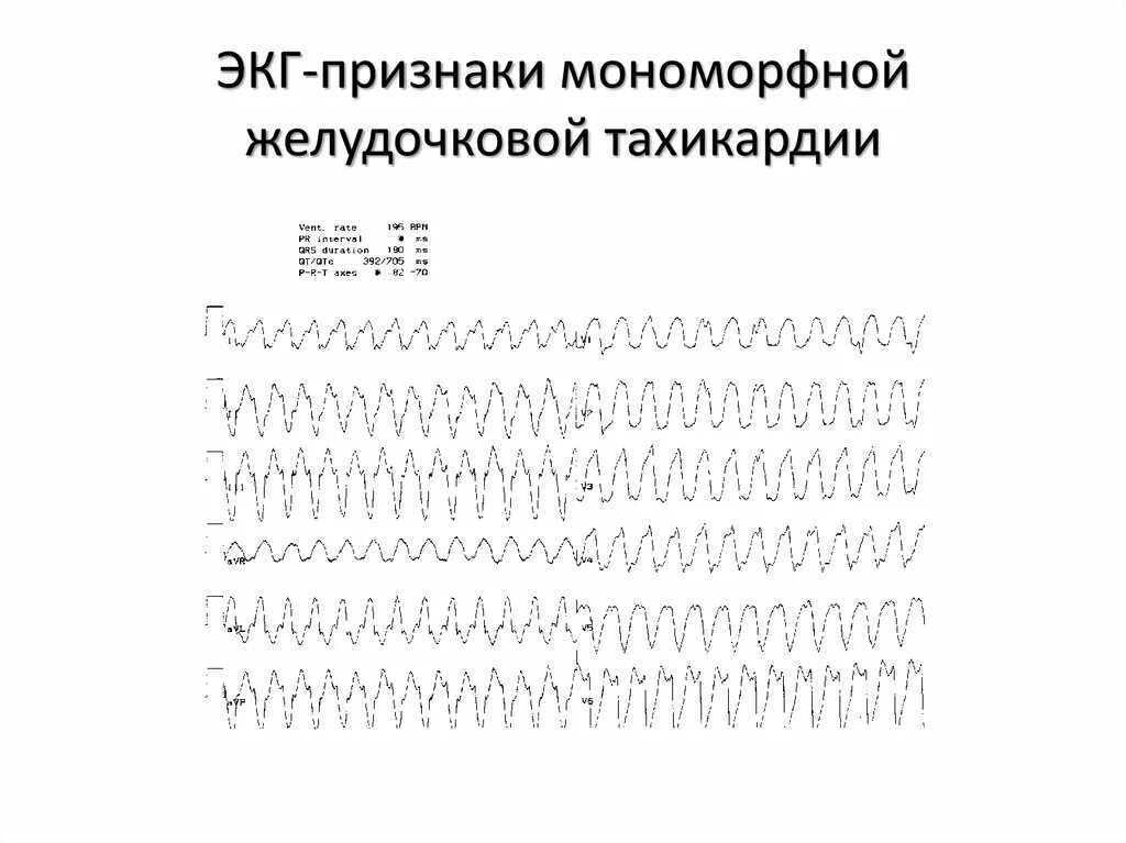 Желудочковая тахикардия на экг. Пароксизмальная мономорфная желудочковая тахикардия ЭКГ. Мономорфная желудочковая тахикардия ЭКГ. Устойчивая желудочковая тахикардия ЭКГ. ЭКГ при желудочковой тахикардии.