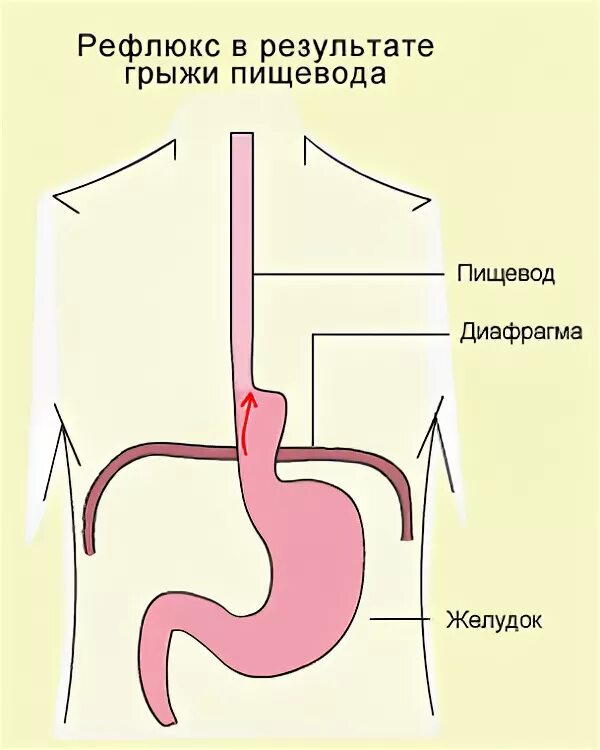 Рефлюкс диафрагмы. Рефлюкс-эзофагит дисфагия. Гастроэзофагеальная рефлюксная болезнь. Рефлекс пищеводного желоба.