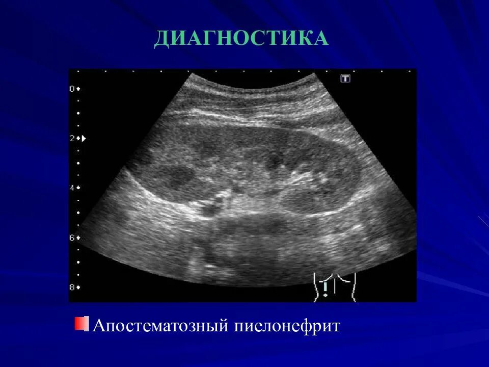 Острый гнойный пиелонефрит. Апостематозный пиелонефрит УЗИ. Нефрит ,пиелонефрит почек. Апостематозный нефрит УЗИ. Апостематозный пиелонефрит патогенез.