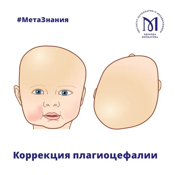 Формы голов детей форум. Плагиоцефалия черепа у детей. плагиоцефалия у новорожденного. плагиоцефалия форма головы. асимметрия черепа у ребенка.