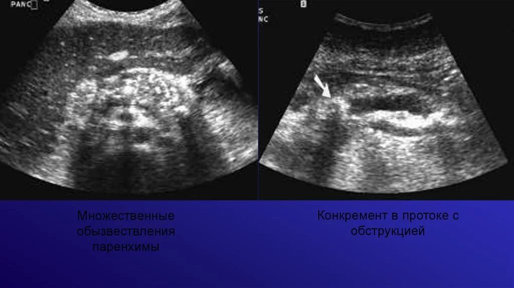 Кальцинат в печени на узи. Пневмобилия желчных протоков УЗИ. Пневмобилия печени на УЗИ. Липоматоз поджелудочной железы на УЗИ. Пневмобилия желчного пузыря на УЗИ.