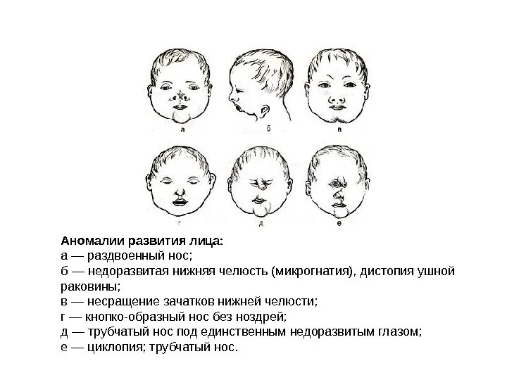 Врожденные пороки развития лица. Пороки развития ушной раковины. Анамалии развитие носа.