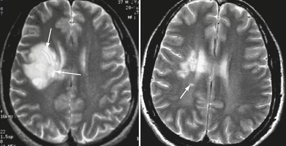 Лейкоэнцефалит