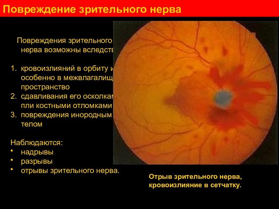 Место выхода зрительного нерва не воспринимающее лучей. Симптомы поврежденного зрительного нерв. Разрыв зрительного нерва. Симптоматика разрыва зрительного нерва. Повреждение глазного нерва.