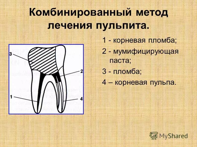 Девитальная ампутация пульпы. Комбинированный метод лечения пульпита. Смешанный метод лечения пульпита. Комбинированный способ лечения пульпита.