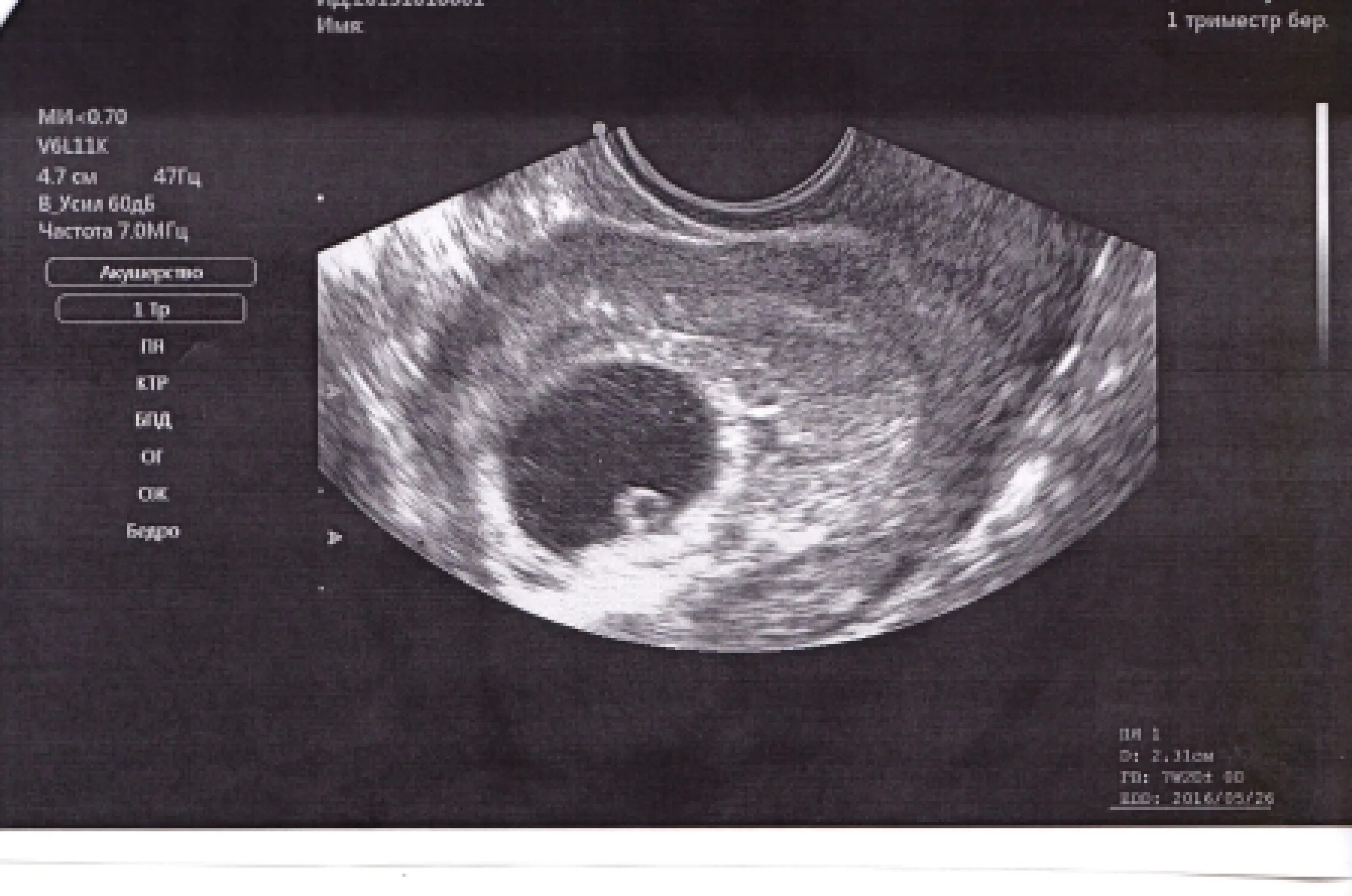Снимок УЗИ эмбриона на 8 неделе беременности. Плодное яйцо на УЗИ 7 недель беременности. УЗИ 2 на 5-6 недели беременности. Плодное яйцо на 6 неделе беременности УЗИ.