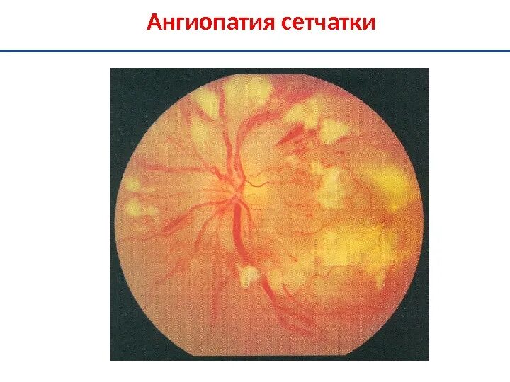 Ангиопатия сосудов глаз. Диабетическая ангиопатия глаз. Диабетическая ангиопатия глазное дно. Гипотоническая ангиопатия сетчатки глаз. Сетчатки по гипертоническому типу