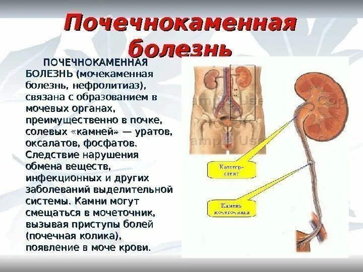 Воспаление почки симптомы и лечение у мужчин. Почечнокаменная болезнь это мочекаменная болезнь. Печечно каменные болезнь. Почечнокаменная болезнь симптомы. Мочекаменная болезнь почек симптомы.