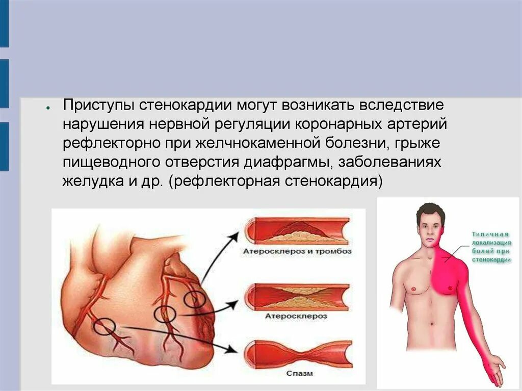 Приступ стенокардии. Рефлекторная стенокардия. Стенокардия возникает вследствие. Стенокардия грудная жаба. Болезнь тургенева грудная жаба