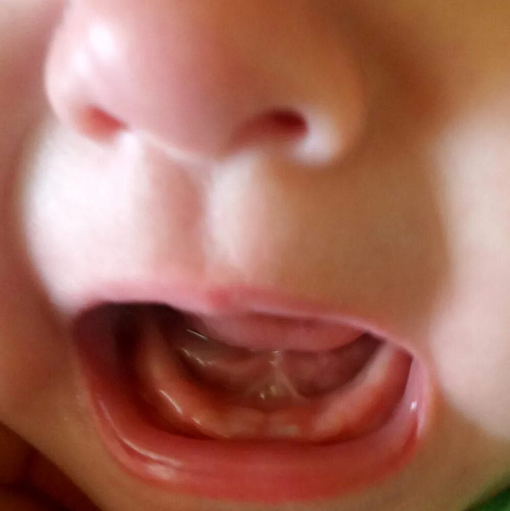 Прорезывание 8 зуба у детей. Прорезываются Верхние зубы. Долго прорезывается зуб. Десна при прорезывании жевательных зубов.