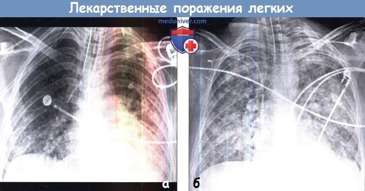 Поражение легких снимки. 100 Процентов поражения легких. Поражением легких 50