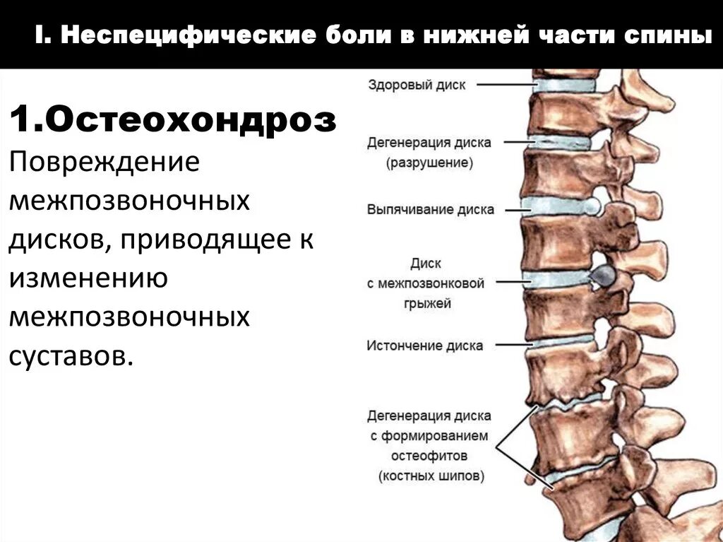 Схема боли в спине. Остеохондроз спины. Болит спина в нижней части позвоночника. Позвоночник больного остеохондрозом.