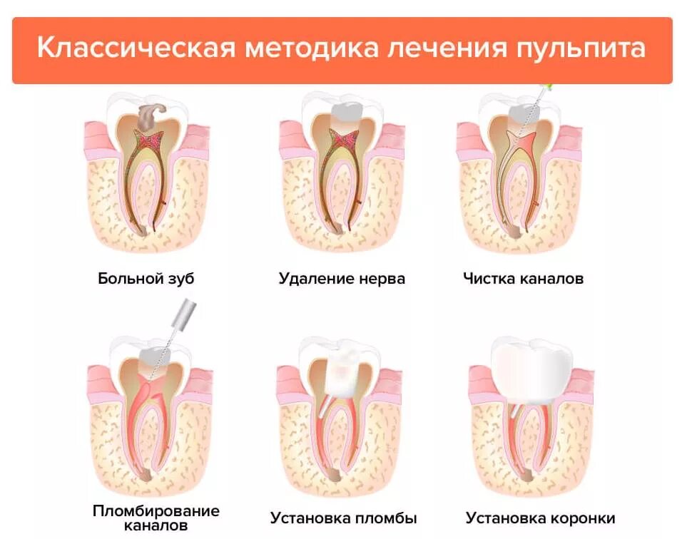 Как снять временную пломбу самостоятельно Световая или обычная пломба: какая лучше для вашей улыбки