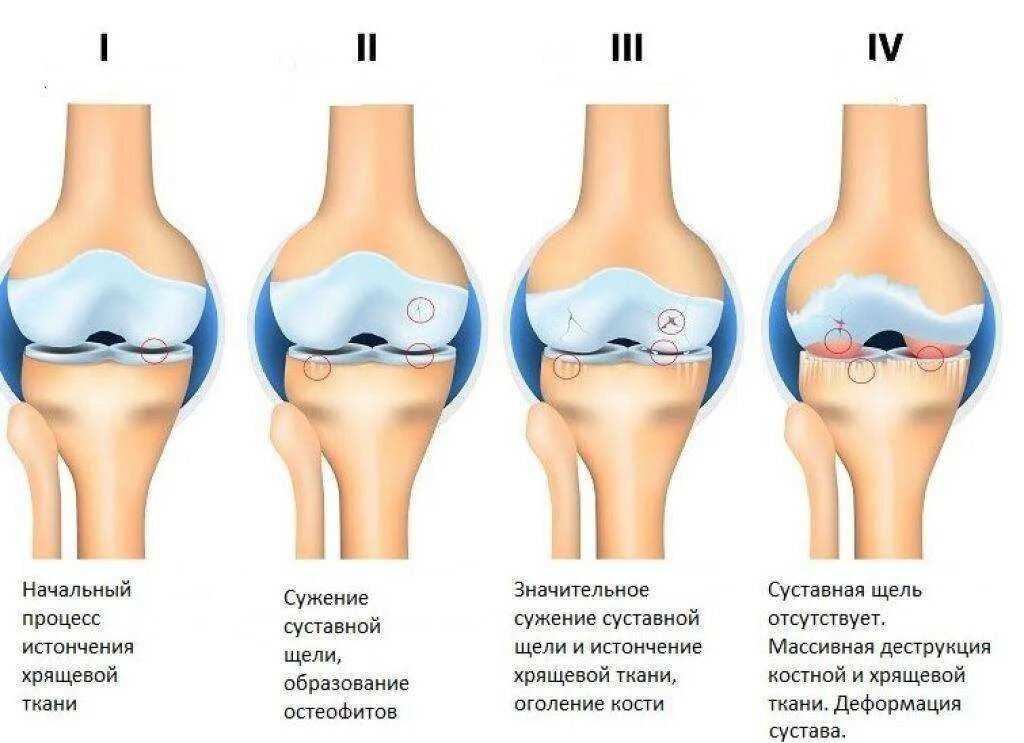 Артроз сколько времени. Остеоартроз коленного сустава степени. деформирующий остеоартроз классификация. разрушение синовиальной хрящевой оболочки. субхондральное утолщение хрящевой ткани суставных поверхностей.
