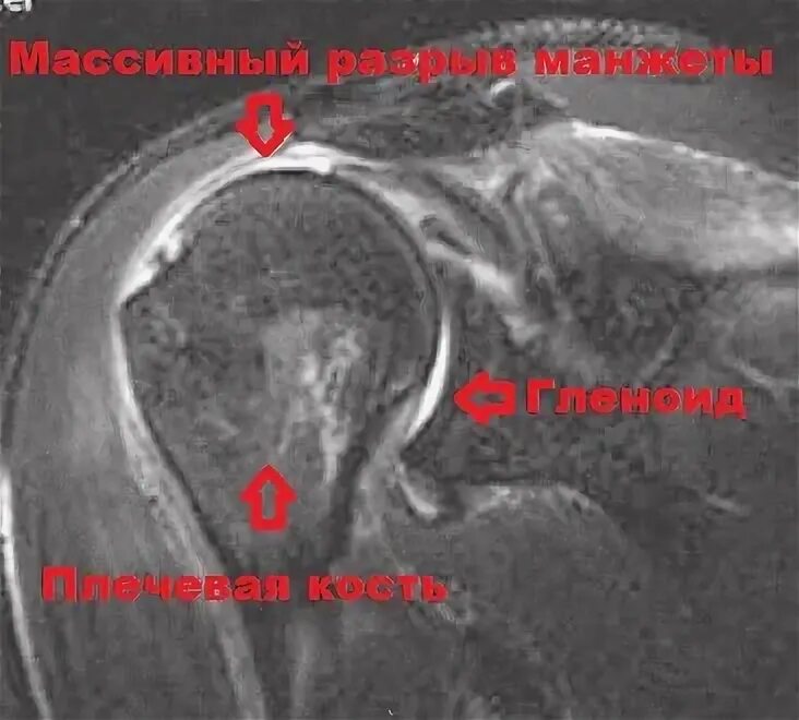 Операция разрыва сухожилия надостной мышцы. Разрыв надостной мышцы плечевого сустава мрт. Тендинит плечевого сустава мрт. Повреждение надостной мышцы плечевого сустава на мрт. Разрыв вращательной манжеты плечевого сустава мрт.