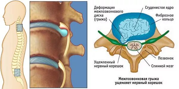 Грыжа позвоночника. Грыжа межпозвоночного диска. Студенистое ядро межпозвоночного диска. С грыжей в позвоночнике берут в армию.