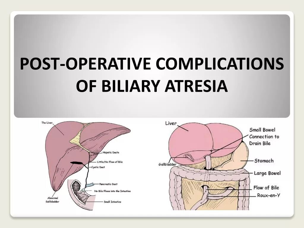 Операций post. Атрезия желчевыводящих путей. Атрезия желчных протоков. Атрезия желчевыводящих путей у новорожденных.
