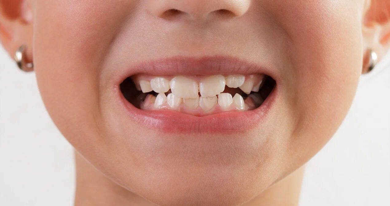 Молочные зубы картинки. Очень кривые зубы у детей.