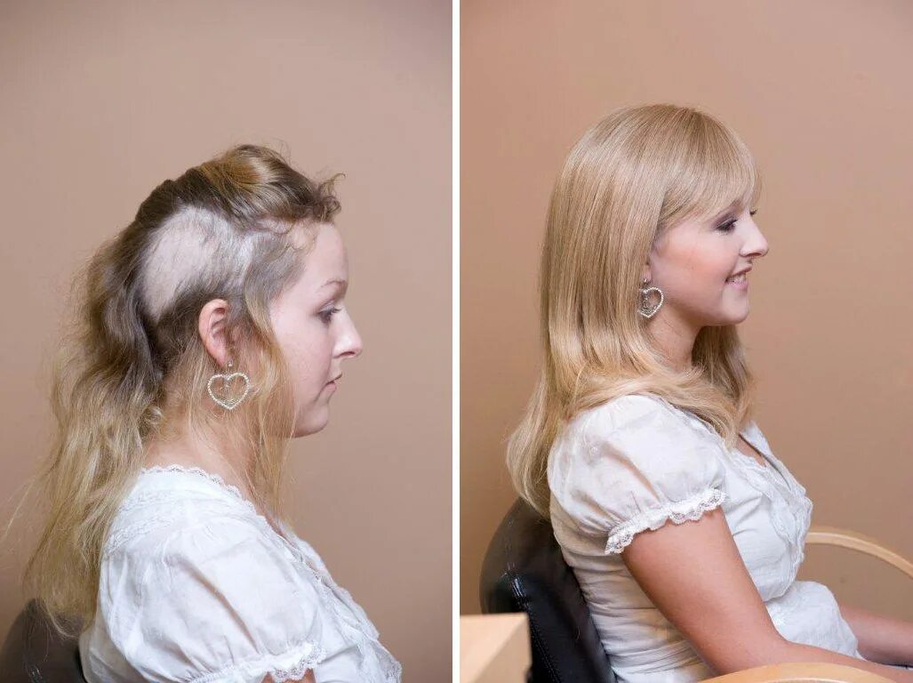 Каррамбэйби трихотилломания. Вырывание волос на голове. Трихотилломания на голове. Волосы после выдергивания. Стрижки с алопецией у женщин.