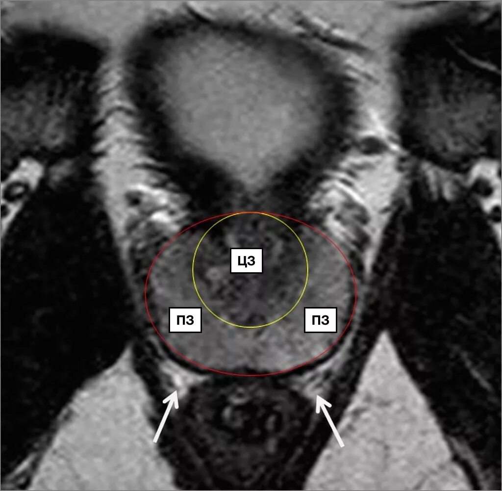 Очаг в предстательной железе. Сегменты предстательной железы мрт. Фибромускулярная Строма предстательной железы это. Зоны предстательной железы мрт. Периферическая зона предстательной железы на мрт.