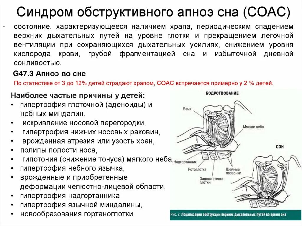 Синдром обструктивного апноэ сна. Синдром обструктивного ап ноя сна. Синдром обструктивного апноэ во СН. Синдром обструктивного гипопноэ. Заболевание апноэ что это