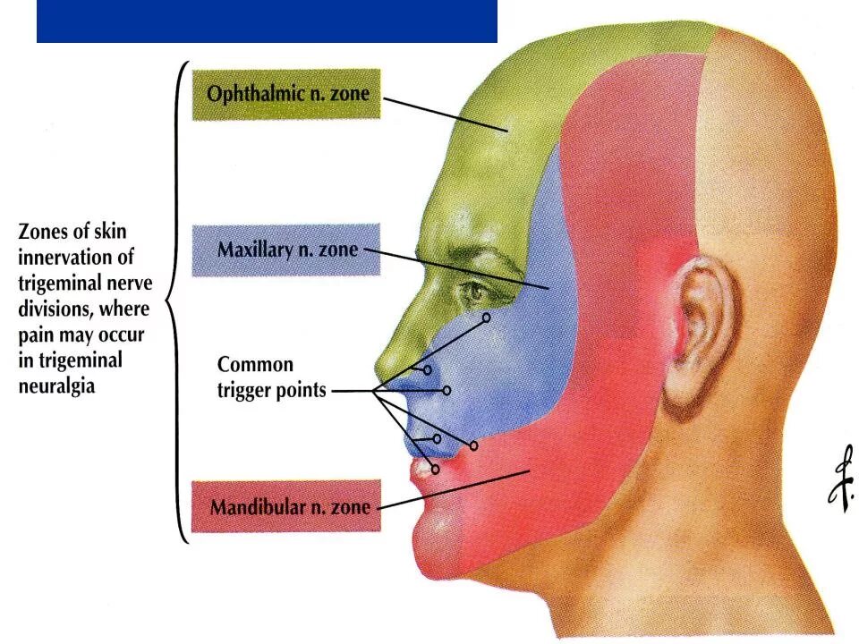 Как отличить зубную боль от тройничного. Точки выхода тройничного и лицевого нерва. Невралгия тройничного нерва 1. Триггерные зоны при невралгии тройничного нерва. Курковые точки тройничного нерва.