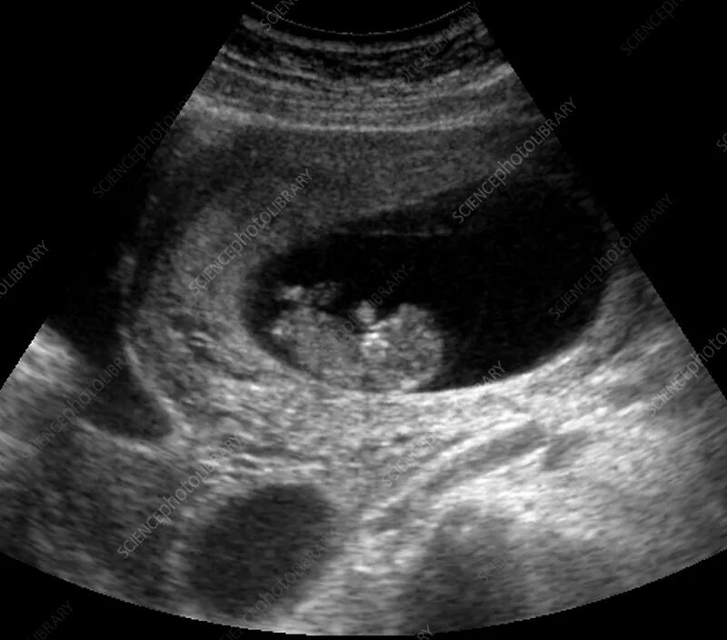 9 недель признаки. 9 Недель беременности фото плода на УЗИ. УЗИ 9-10 недель беременности. УЗИ на 9 неделе беременности плода на УЗИ. Снимок УЗИ 9-10 недель беременности.