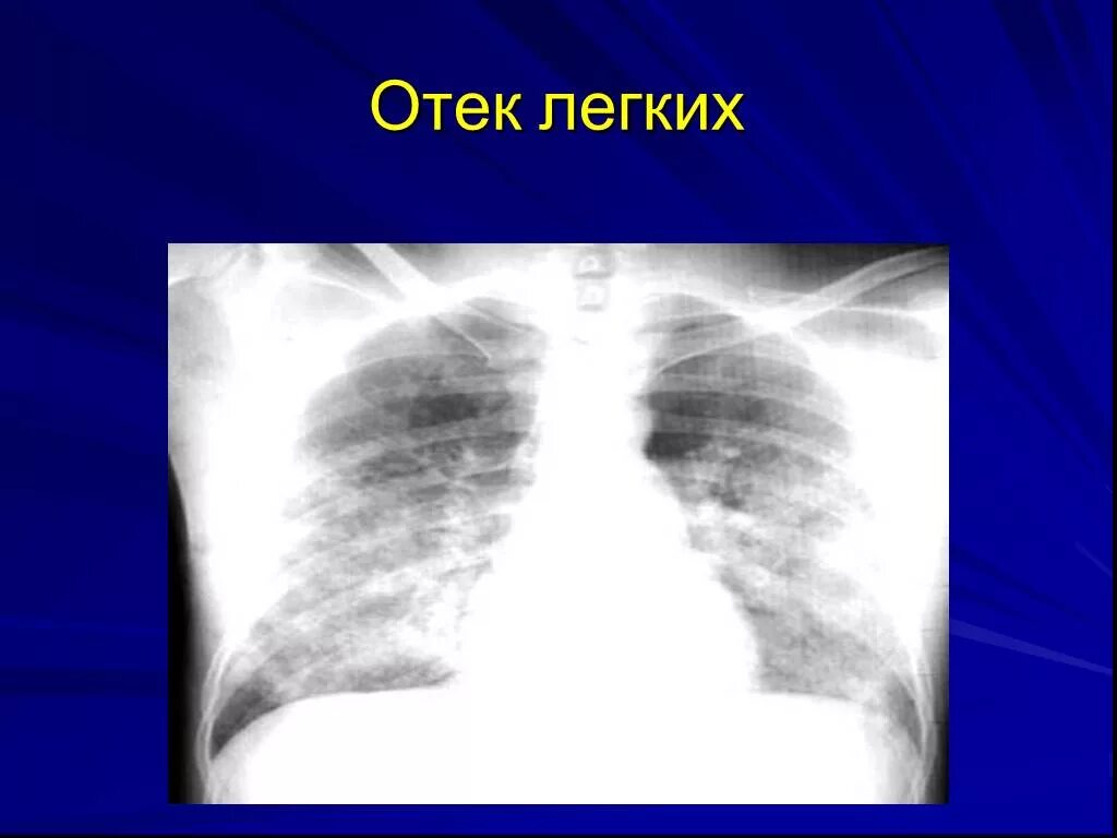 Отёк легкого на рентгенограмме. Отек легкого на рентгенограмме. Альвеолярный отек легких рентген. Отек легких рентген.