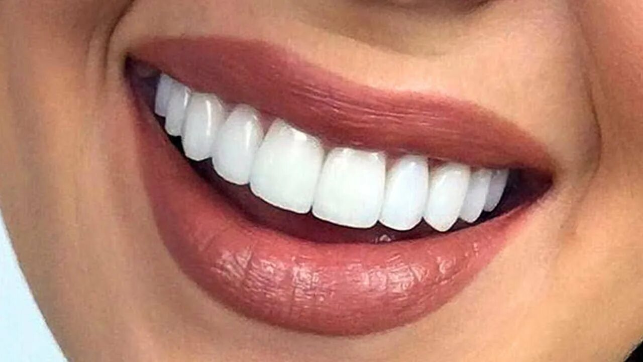 Идеальные зубы. Красивые зубы виниры. Белоснежные виниры. Эстетическая стоматология виниры.
