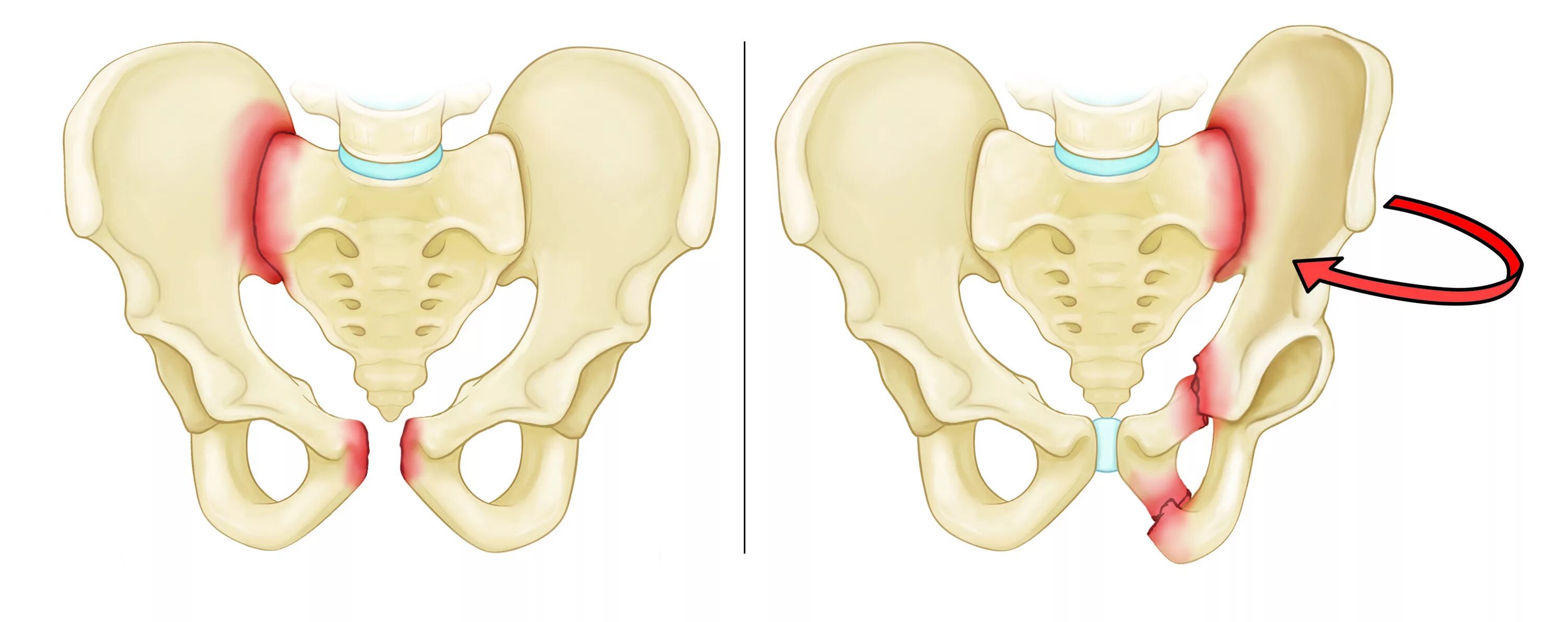 Разрыв крестцов. Перелом лонного сочленения таза. Кости таза лонное сочленение. Перелом лонного сочленения рентген. Симфиз тазобедренного сустава.