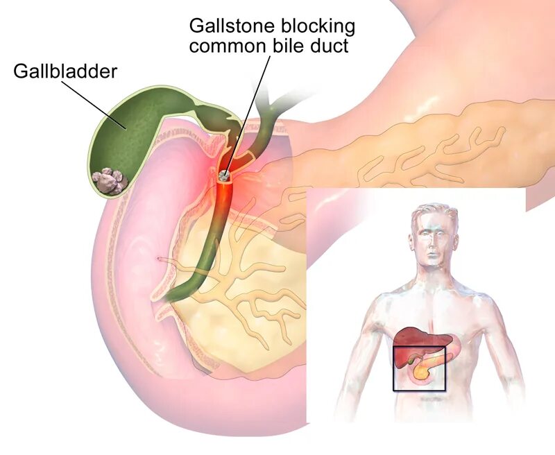 Боли в желчном пузыре почему. Болезни желчного пузыря. Желчекаменная болезнь. Камни в желчном пузыре у женщин.