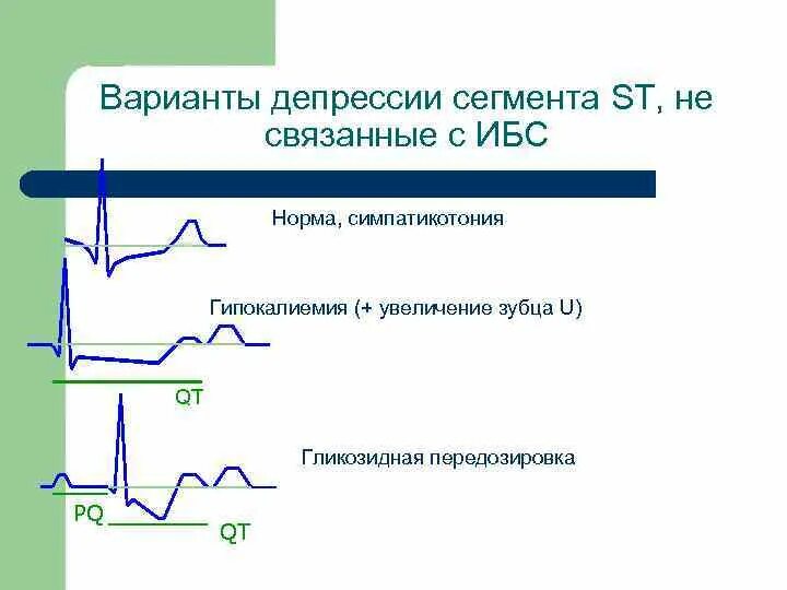 Депрессия сегмента st. Депрессия сегмента St на ЭКГ v5 v6. Корытообразная депрессия сегмента St. Депрессия и элевация сегмента St. Косонисходящая депрессия сегмента St на ЭКГ.