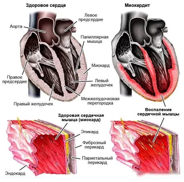 Воспаление миокарда миокардит. Миокардит сердечной мышцы симптомы. Эндокардит миокардит перикардит. Воспаление миокардит симптомы.