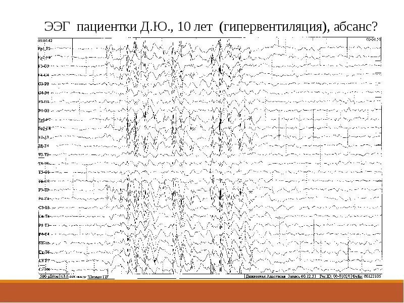 Юношеская миоклоническая эпилепсия ЭЭГ. Миоклонус эпилепсия на ЭЭГ. Юношеская абсанс эпилепсия ЭЭГ. Миоклонический приступ на ЭЭГ. Юношеская эпилепсия
