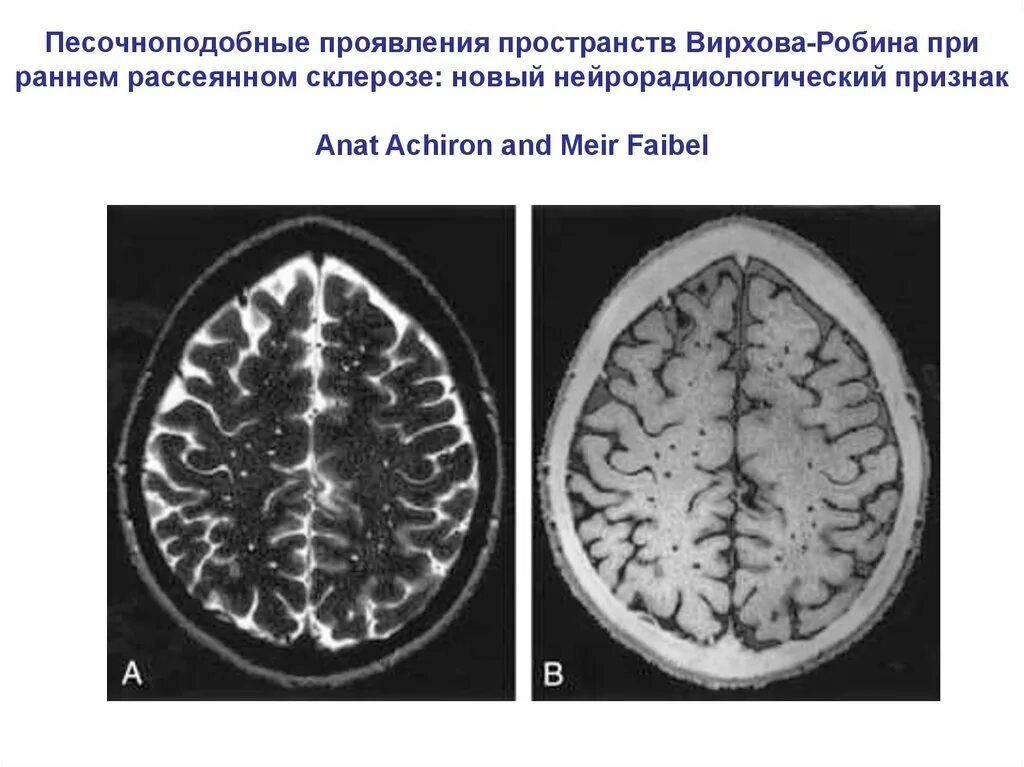 Склероз мозга. Расширение периваскулярных пространств Вирхова-Робина на мрт. Периваскулярные пространства Вирхова-Робина расширены. Пространства Вирхова-Робина мрт. Расширение пространства Вирхова Робина на мрт.