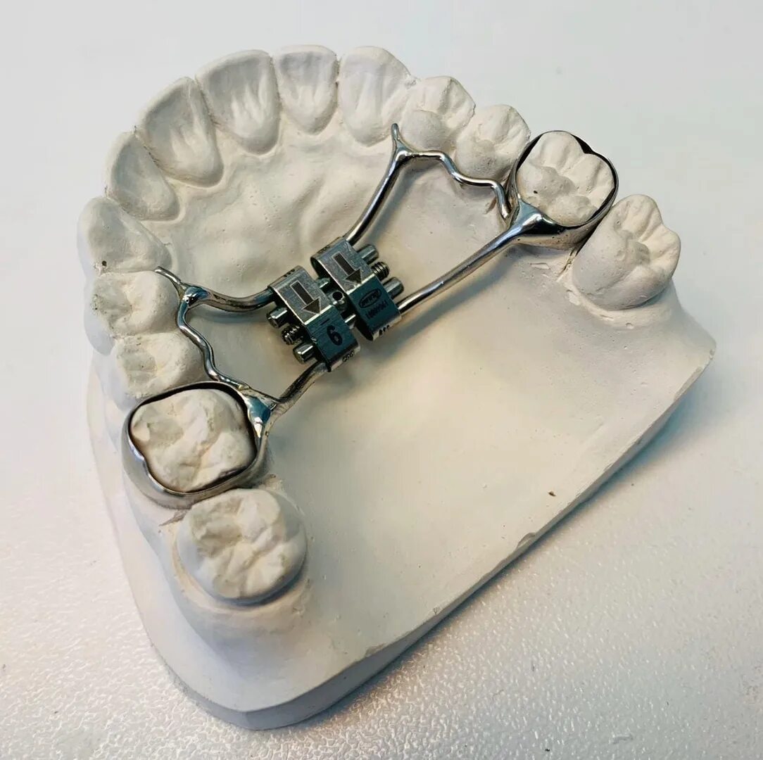 Аппарат Твин блок ортодонтия. Ортодонтический аппарат Твин блок (Twin Block). Дерихсвайлера ортодонтический аппарат. Аппарат для расширения верхней челюсти аппарат Дерихсвайлера. Аппарат хасса