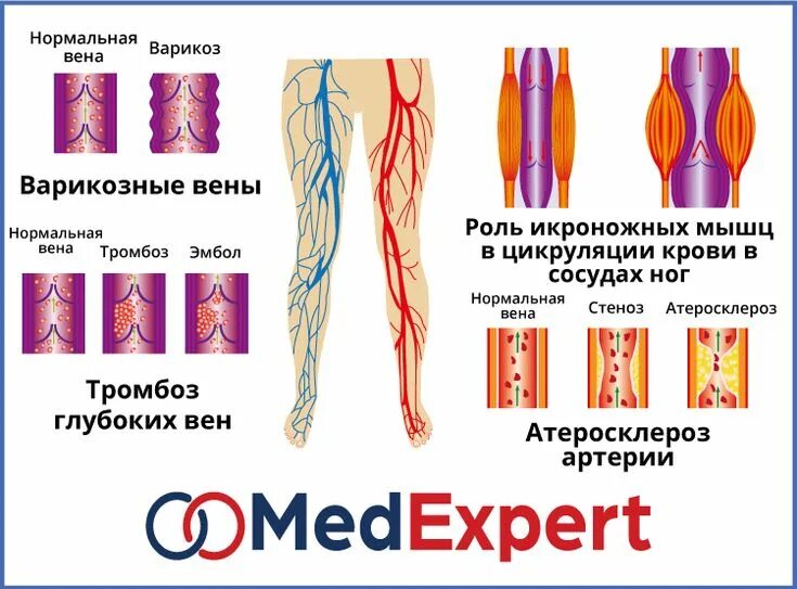 Болезни кровеносного сосуда. Варикозное расширение вен нижних конечностей ХВН 1 ст. Венозная недостаточность сосудов.